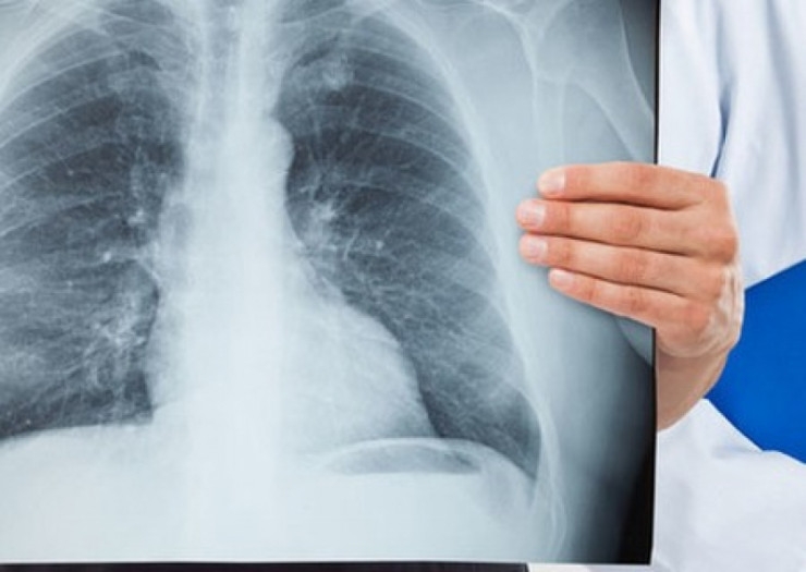 В Коми больных туберкулезом становится меньше